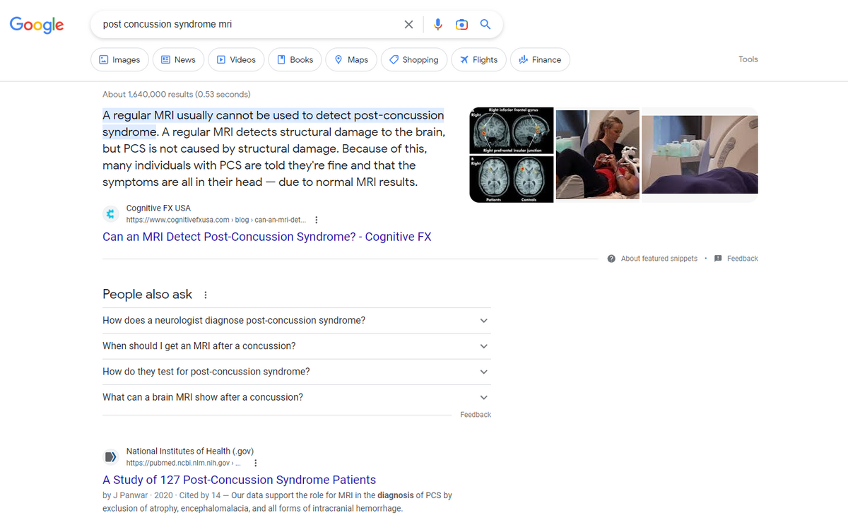 Cognitive FX featured snippet for post concussion syndrome mri.